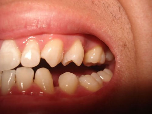 Tình trạng răng miệng quyết định chi phí điều trị trám răng