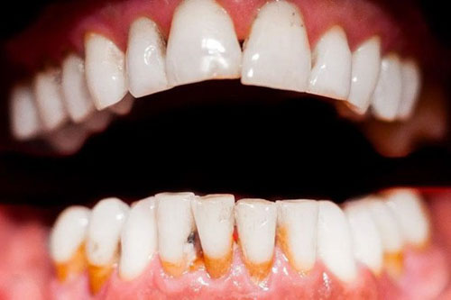 Tình trạng răng miệng truocs khi bọc sứ