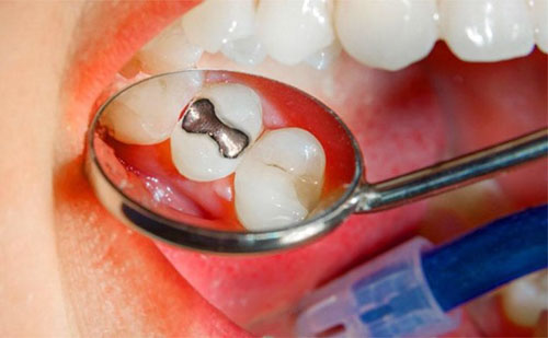 Trám răng Amalgam có tuổi thọ lâu dài