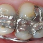 Trám răng bằng chì có độc không? Khi nào nên trám?
