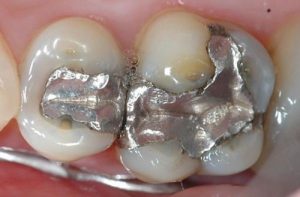 Read more about the article Trám răng bằng chì có độc không? Khi nào nên trám?