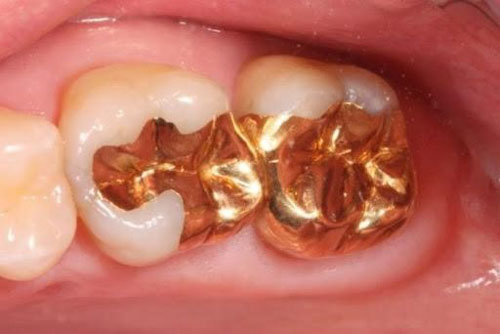 Trám răng bằng vàng