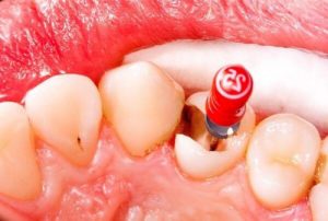 Read more about the article Trám răng có cần lấy tủy không? Chi phí là bao nhiêu?