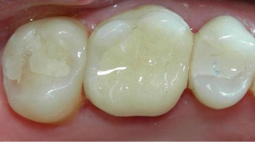 Trám răng Composite mang tính thẩm mỹ cao