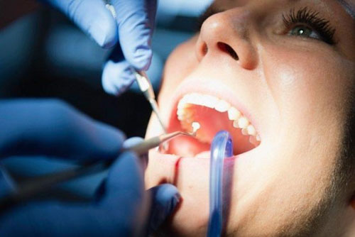 Trám răng composite nha khoa có tốt không?