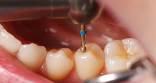 Trám răng Composite phục hình răng khiếm khuyết