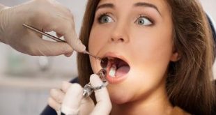 Trám răng mất thời gian bao lâu?