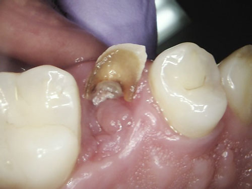 Trám răng tại nhà có nguy cơ gây mất răng