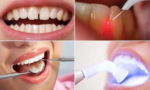 Trám răng tại nha khoa theo từng bước khoa học