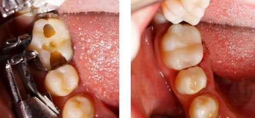 Trám răng thẩm mỹ cho trẻ phòng ngừa sâu răng
