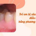 Trẻ em bị sâu răng hàm: CÁCH ĐIỀU TRỊ và phòng ngừa hiệu quả