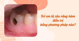 Read more about the article Trẻ em bị sâu răng hàm: CÁCH ĐIỀU TRỊ và phòng ngừa hiệu quả