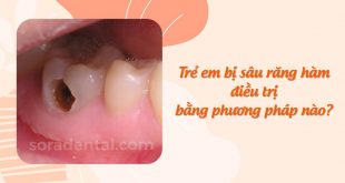 Trẻ em bị sâu răng hàm: CÁCH ĐIỀU TRỊ và phòng ngừa hiệu quả