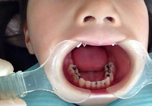 Trẻ em bị sâu răng hàm