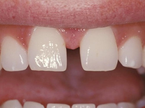 Trường hợp răng thưa lớn không thể áp dụng trám răng