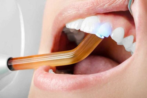 Ứng dụng công nghệ trám răng hiện đại