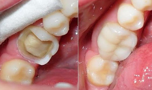Vật liệu dùng trám răng tạm thời