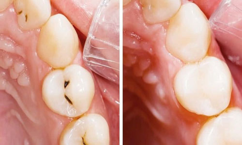 Vật liệu trám răng Composite cao cấp