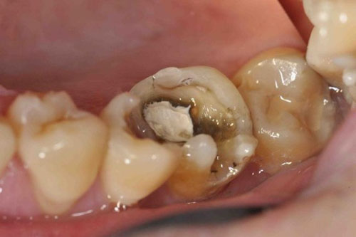 Vi khuẩn sâu răng ăn mòn men răng