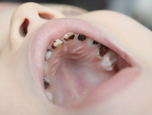 Vì sao trẻ dễ mắc sâu răng?