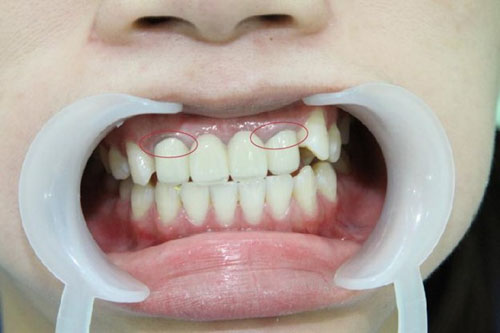 Nhược điểm răng sứ Titan
