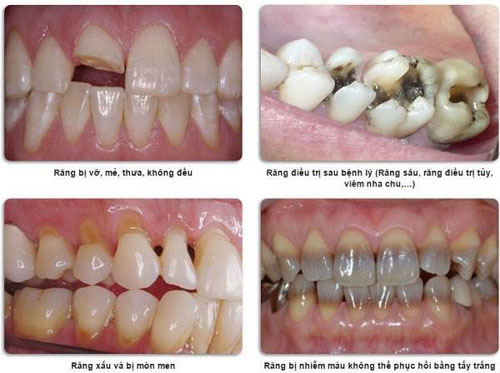 Bọc răng sứ áp dụng cho mọi tình trạng răng miệng