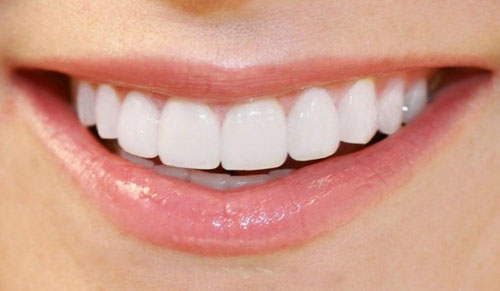 Bọc răng sứ có thể tẩy trắng răng được không?