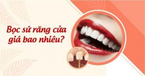 Read more about the article Bọc sứ răng cửa giá bao nhiêu? Loại nào tốt nhất?