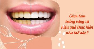 Read more about the article Cách làm trắng răng sứ tại nhà có thực sự hiệu quả?