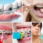 Cách vệ sinh răng miệng khi niềng răng hiệu quả