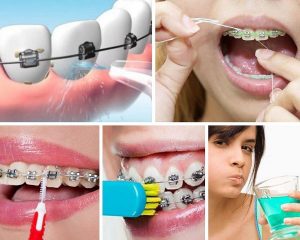 Read more about the article Cách vệ sinh răng miệng khi niềng răng hiệu quả