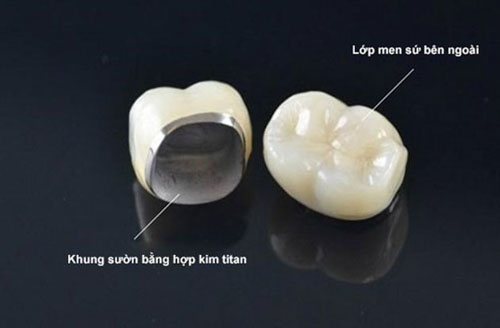 Cấu tạo răng kim loại