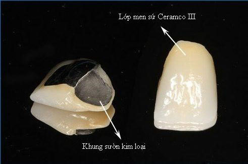 Cấu tạo răng sứ Ceramco