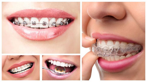 Chỉnh hình răng giúp bảo tồn tối đa răng thật