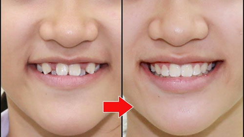 Chỉnh hình răng giúp sắp xếp các răng mọc đều đặn, thẳng hàng