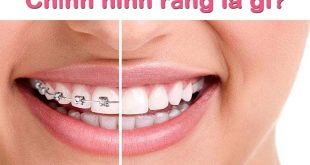 Chỉnh hình răng là gì? Những vấn đề cần biết về chỉnh hình răng