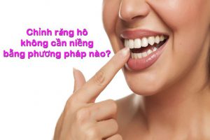 Read more about the article Chỉnh răng hô không cần niềng bằng phương pháp nào?