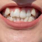 Chỉnh sửa răng khểnh bằng phương pháp nào hiệu quả?