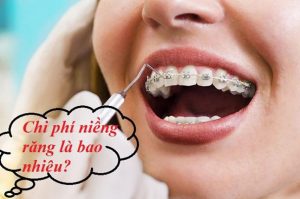 Read more about the article Giá niềng răng rẻ nhất là bao nhiêu tiền?
