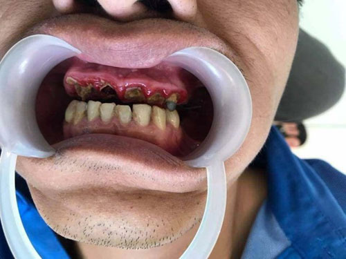 Hiểu rõ tình trạng răng miệng bản thân