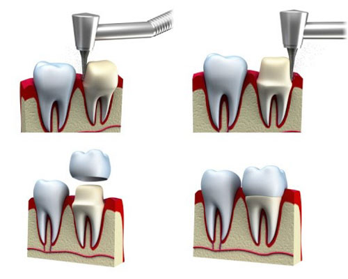 Hình ảnh mô phỏng phương pháp bọc răng sứ thẩm mỹ