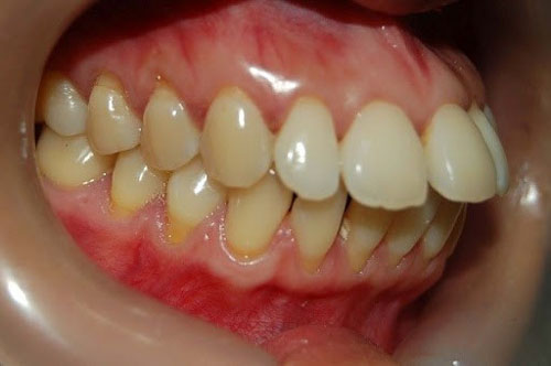 Hô do cả răng và hàm cần điều trị kết hợp niềng răng và phẫu thuật hàm