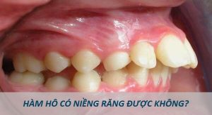Read more about the article Hô hàm có niềng răng được không?