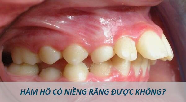 Read more about the article Hô hàm có niềng răng được không?