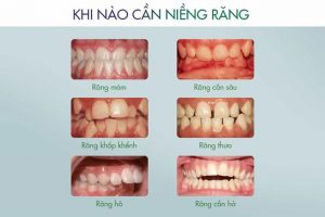 Read more about the article Khi nào nên niềng răng? Và trường hợp nào nên niềng?