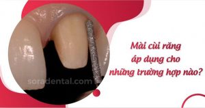 Read more about the article Kỹ thuật mài cùi răng những trường hợp nào áp dụng