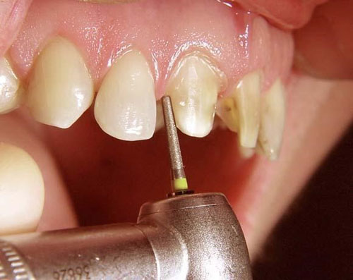 Kỹ thuật mài răng quyết định bọc răng sứ đau không