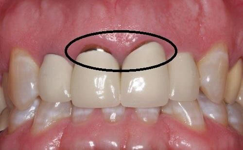 Lộ khuyết điểm viền răng kim loại