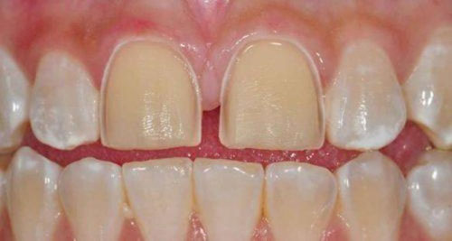 Mài cùi răng có ảnh hưởng gì không?