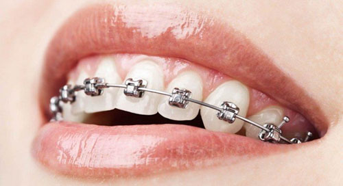 Niềng răng mắc cài 3M kim loại (3M UGSL)